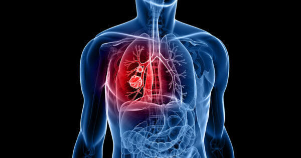 Cancer pulmonar 