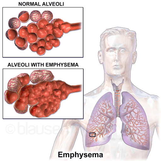 emfizem-alveole-normale-patologic
