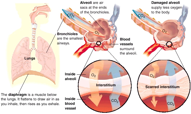 Afectarea schimburilor gazoase în boala pulmonară interstițială asociată sclerodermiei