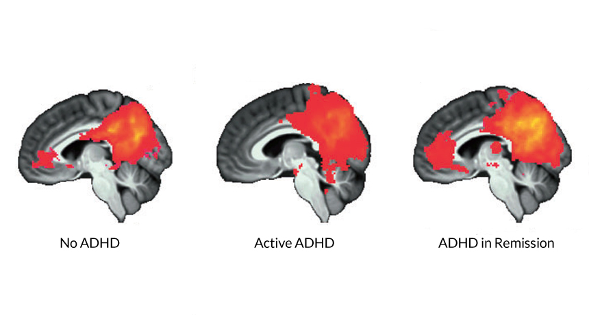 Aspect cerebral în cazul: absenței ADHD, activității bolii, ADHD în remisie