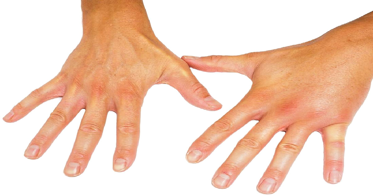 semne ale bolii articulare autoimune dureri articulare pe brațul drept