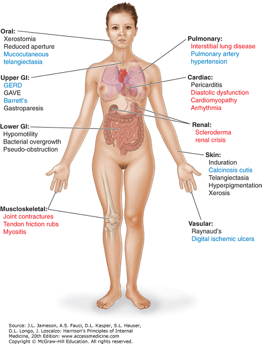 Sclerodermie - afectare multipla de organe