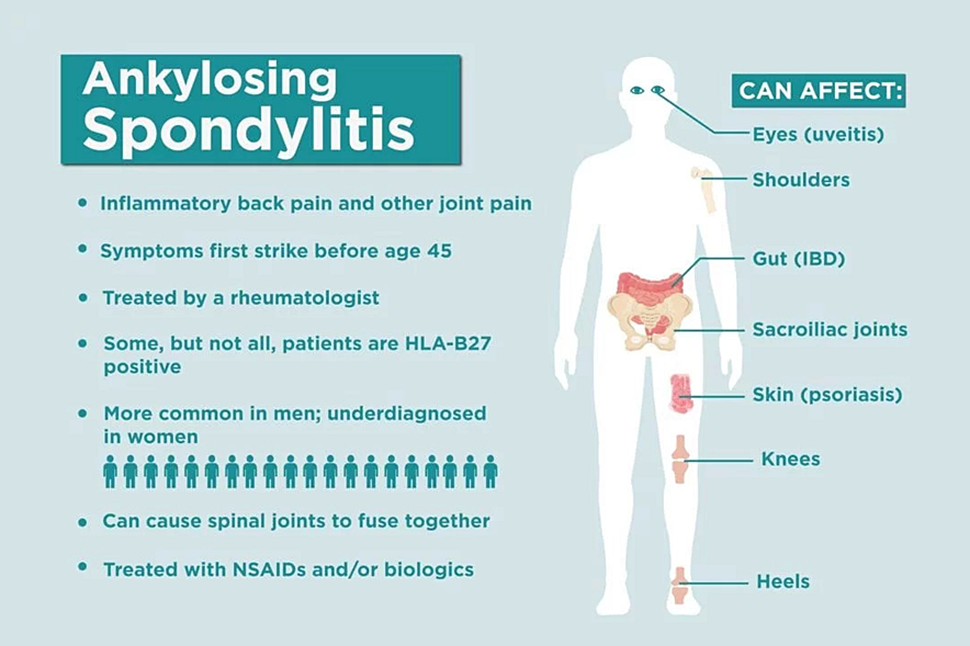infografic spondilita anchilozanta simptome