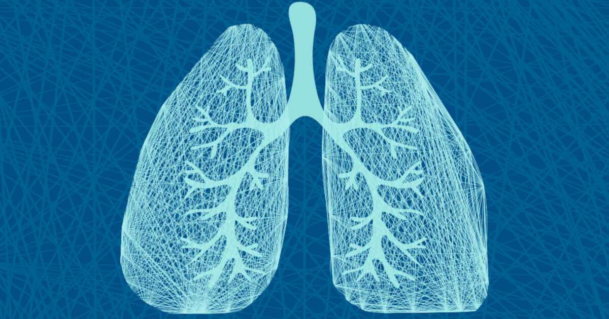 Imaginea ilustrează plămânii - cancerul pulmonar