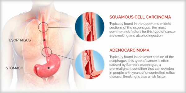 Tipurile de cancer esofagian