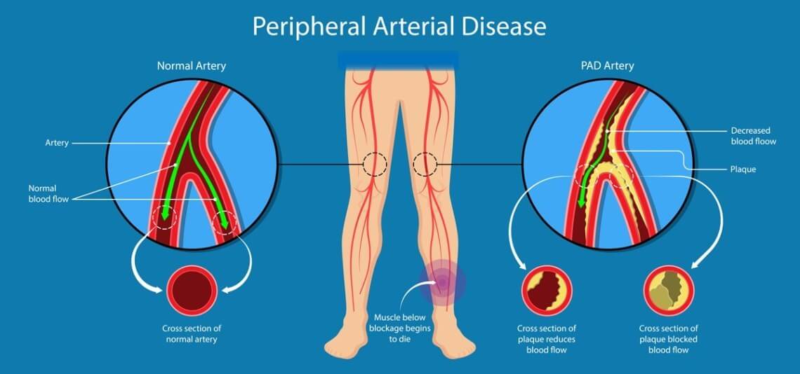 Afectarea aterosclerotică in boala vasculara periferica
