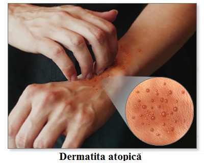 Aspectul pielii în dermatita atopică
