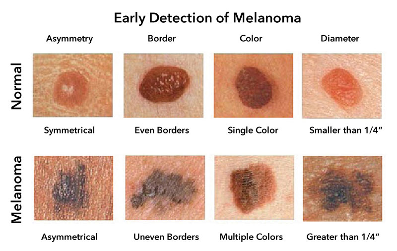 Detecția precoce a melanomului prin recunoașterea semnelor clinice caracteristice - metoda ABCD