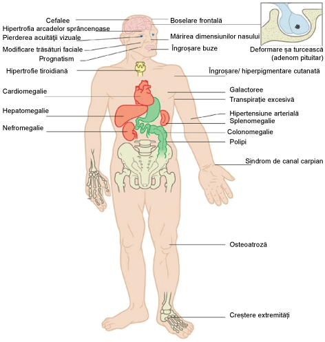 Corp uman cu legături către simptomele principale ale acromegaliei