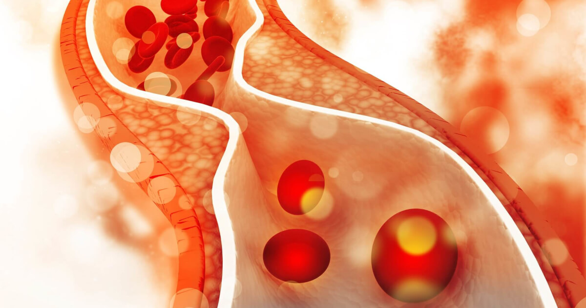 Afectare vasculară în hipercolesterolemia familială