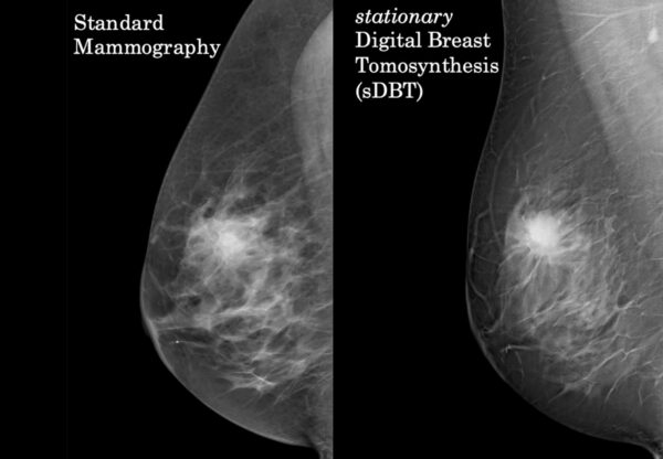 Mamografie digitală comparație mamografie cu tomosinteză