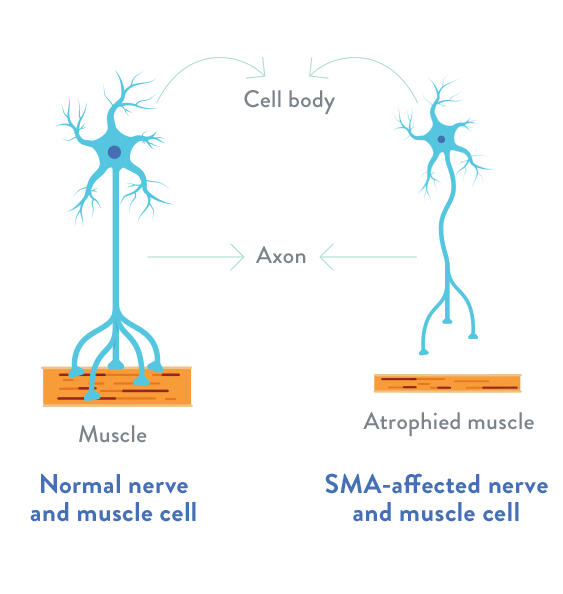 Neuron motor și țesut muscular normal versus neuron motor afectat și țesut muscular atrofiat în atrofia musculară spinală