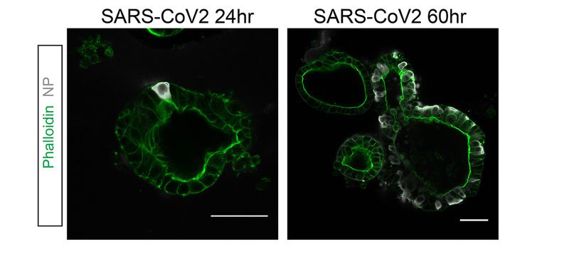 Imagine imunohistochimie infecție SARS-CoV-2 epiteliu intestinal