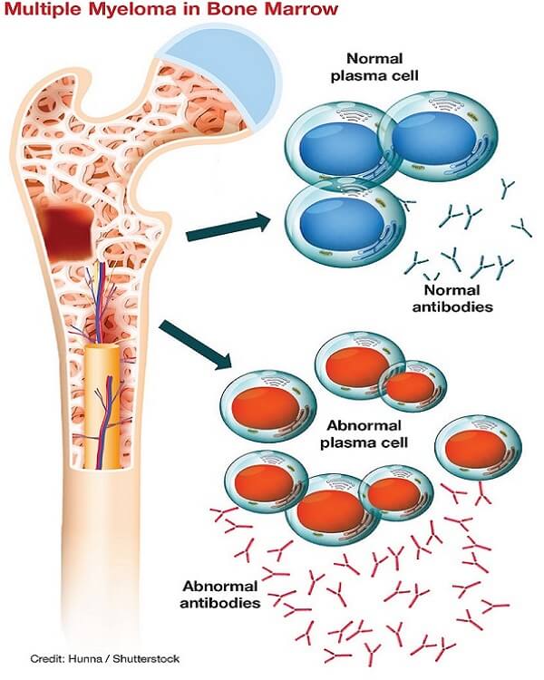 mielomul multiplu la nivelul maduvei osoase hematogene