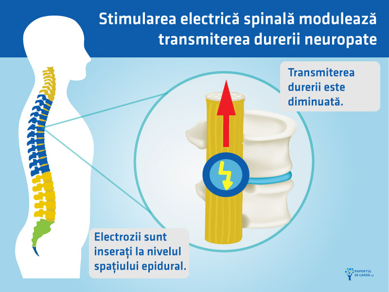 Stimulare electrica spinala durere neuropata