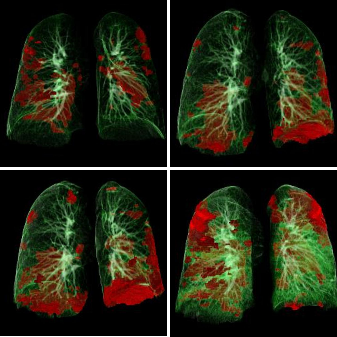 Imagini CT leziuni pulmonare COVID0-19